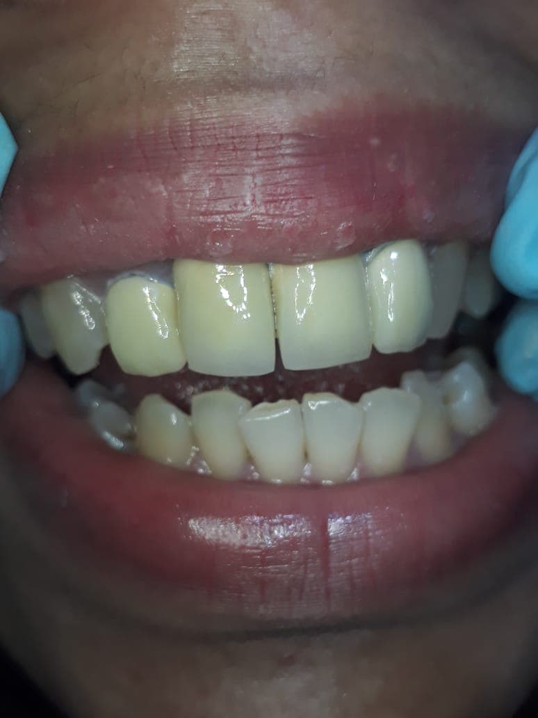 Dental Bridge Sesudah [1]